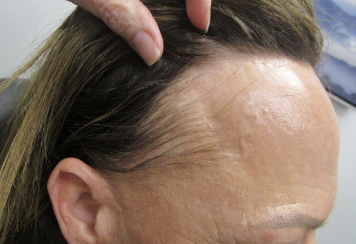 A New Epidemic Frontal Fibrosing Alopecia Skin Bones CME